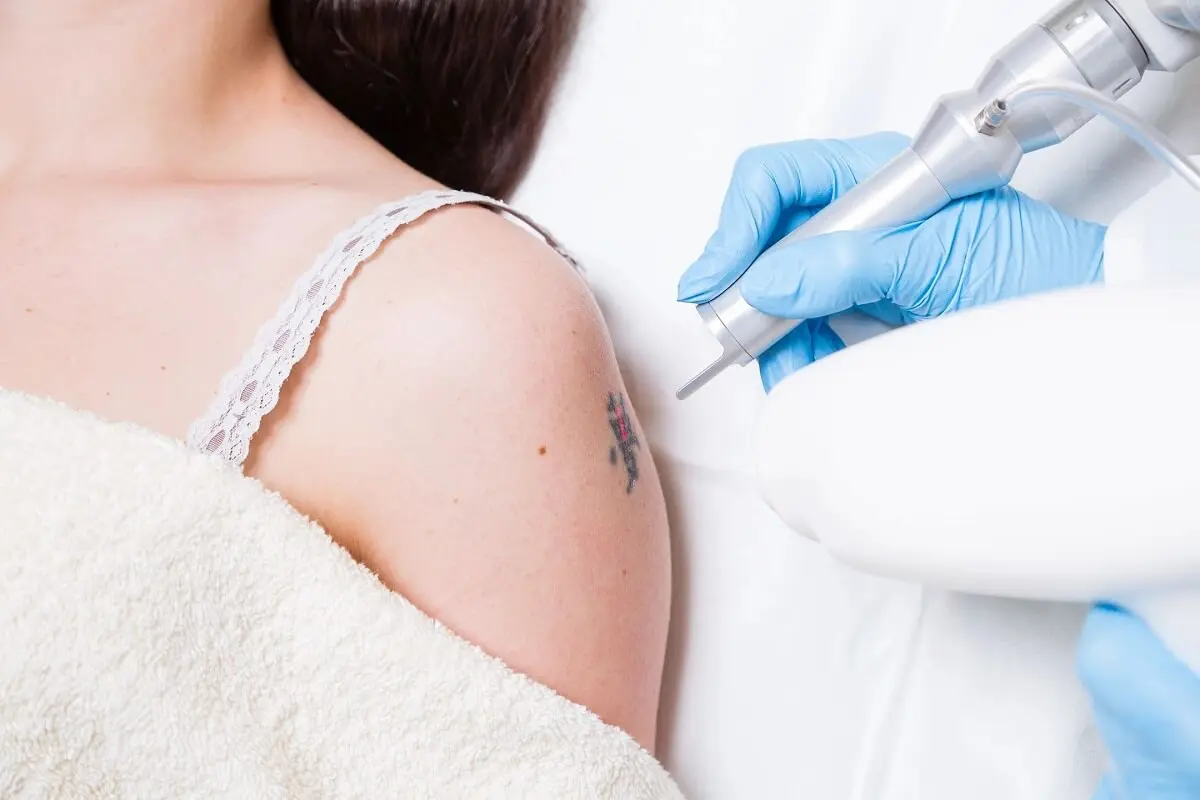 A woman getting her tattoo removed by an esthetician.